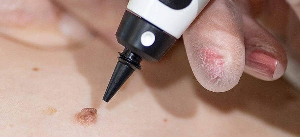After Skin Tag Removal Greenock