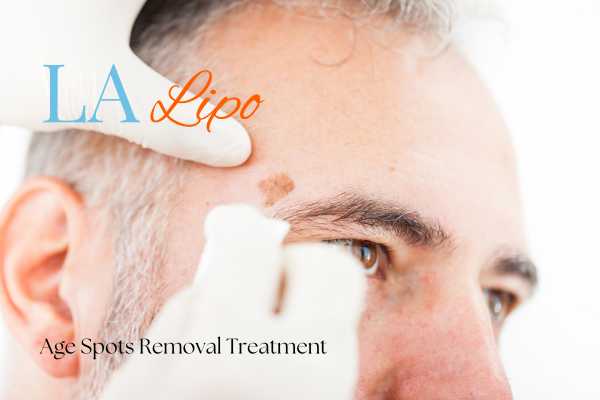 What Are the Most Effective Treatments for Age Spots Greenock ?