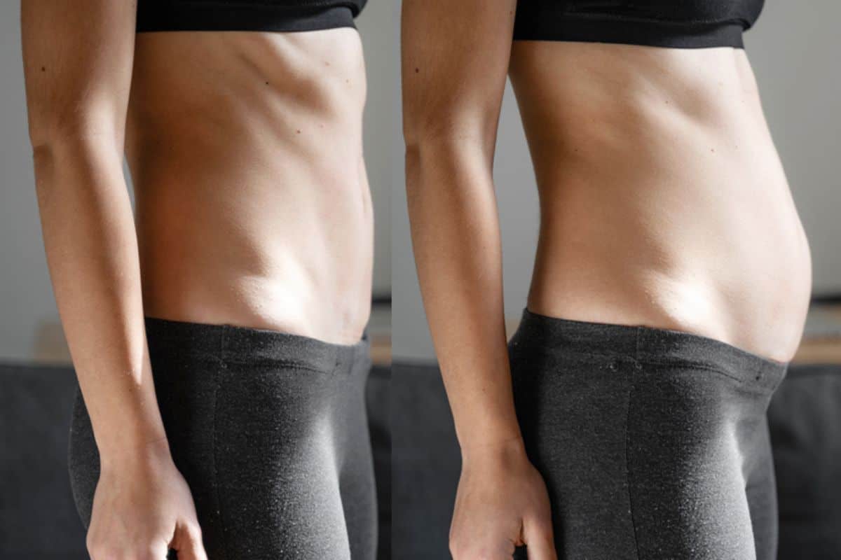 How long does diastasis recti take to improve Greenock ?