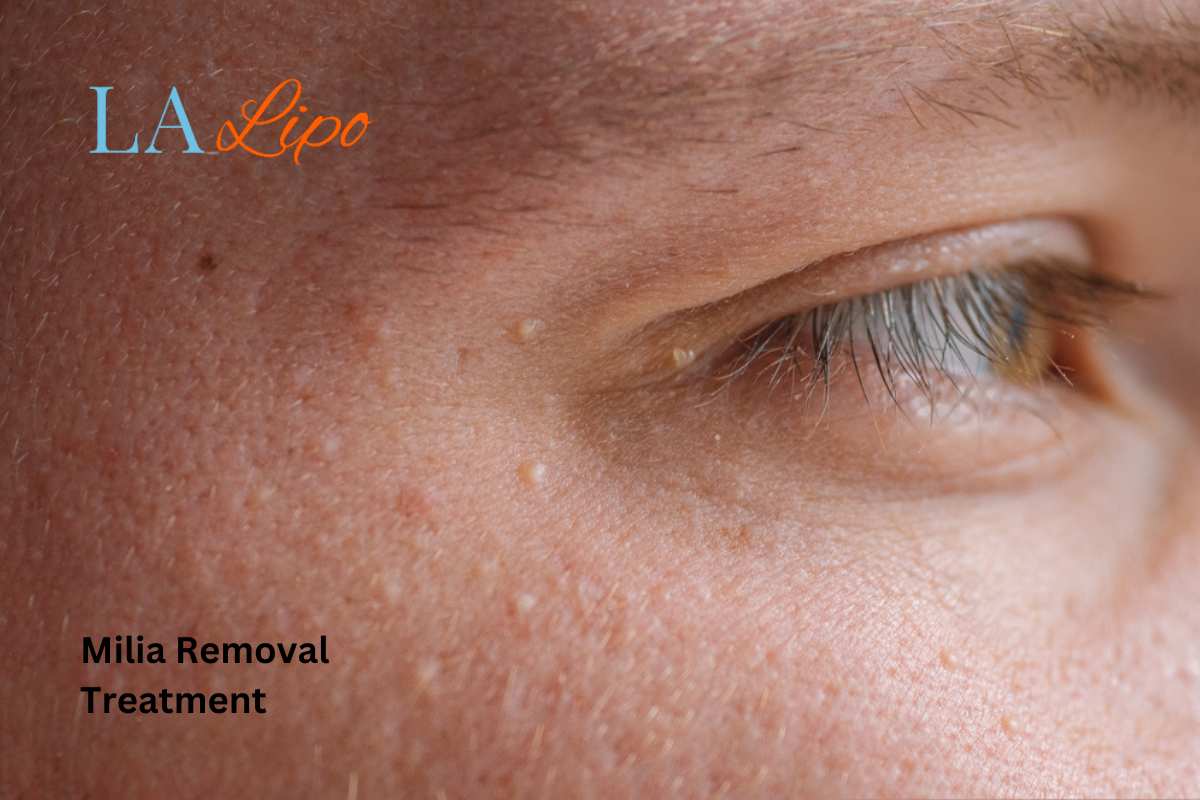 Cryopen Milia Removal: Is It the Easiest and Safest Option Greenock ?