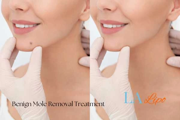 woman's before and after mole removal Greenock results