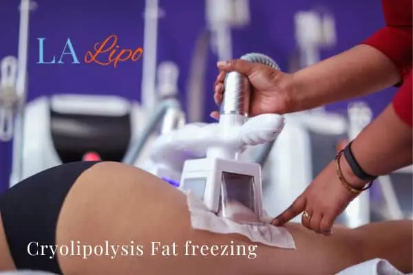 women getting fat freezing Greenock