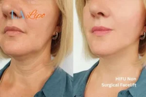 hi-fu for wrinkles Greenock before and after results