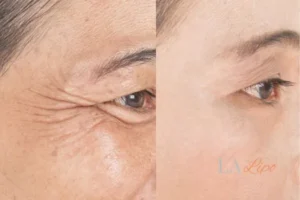 Before and after results of woman - HI-fu wrinkles reduction treatment Greenock