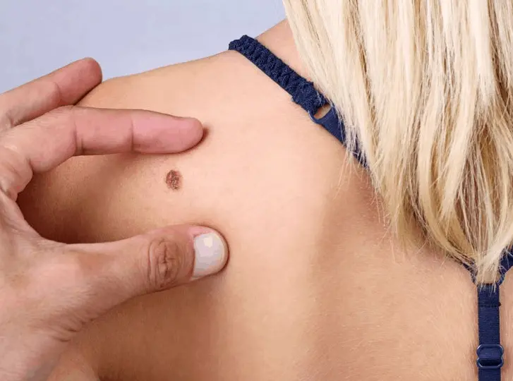 woman having mole removal Greenock consultation before treatment.