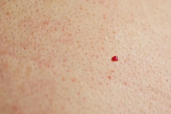 close up of a cherry angioma Greenock 