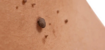 image of a skin tag Greenock