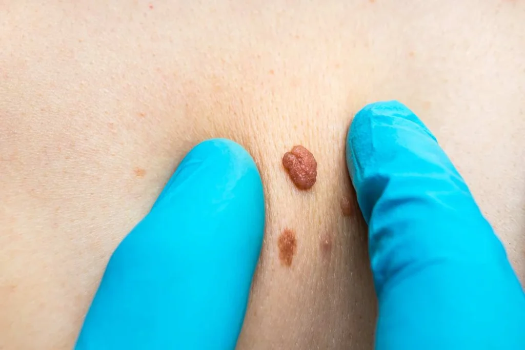 Consultant examining a skin tag Greenock