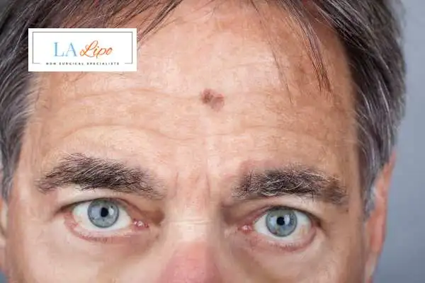 Solar Lentigo Removal Greenock image of man with mark on his forehead
