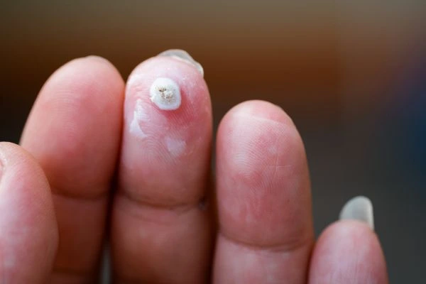 wart on person finger - cryotherapy to treat from LA LIPO Greenock