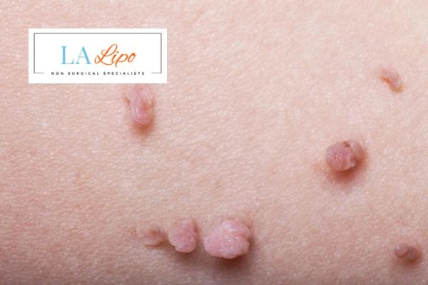 Does cryopen skin tag removal Greenock hurt? Find out now call our team today!
