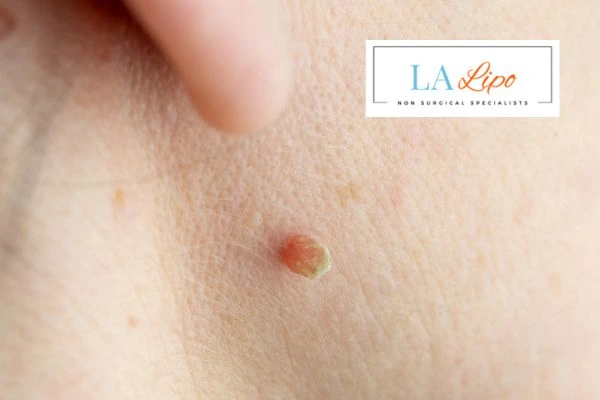 Book skin tag removal Greenock today speak to our team now!