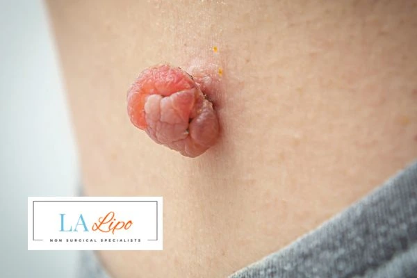 Interested in skin tag removal Greenock ? Concerned about the pain? Find out more today!