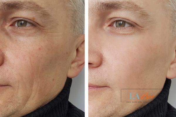 See the amazing results of Morpheus8 Treatment Greenock !