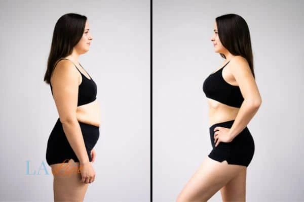 Picture of womans before and after using LA-EMS body sculpting to improve her core strength Greenock
