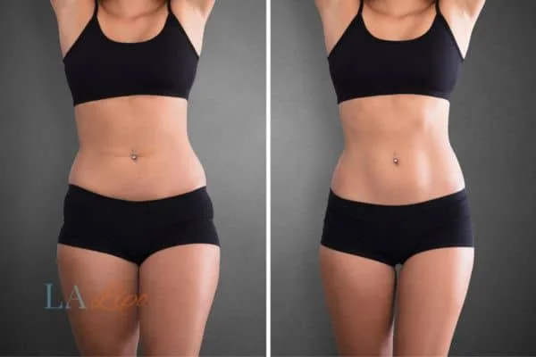before and after results of non-surgical treatment to help a woman's body image and mental health Greenock