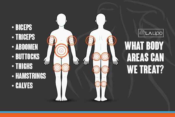 Diagram to show areas you can have LA-EMS Body Sculpting Treatment Greenock