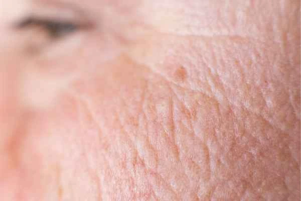close up picture of a woman's face showing an age spot Greenock