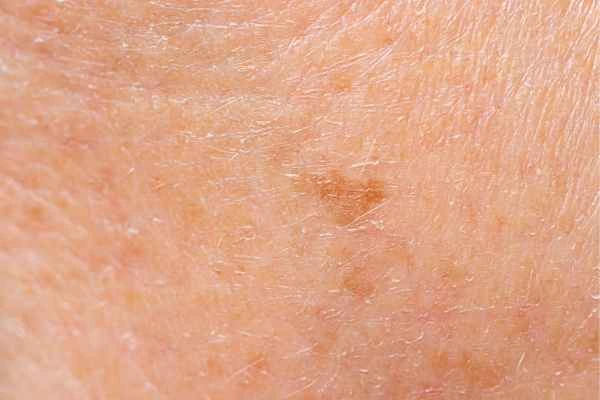 close up picture of age spots Greenock 