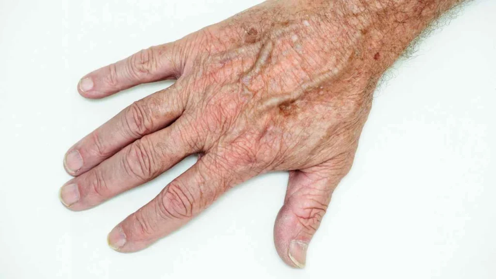 Male hand showing age spot Greenock