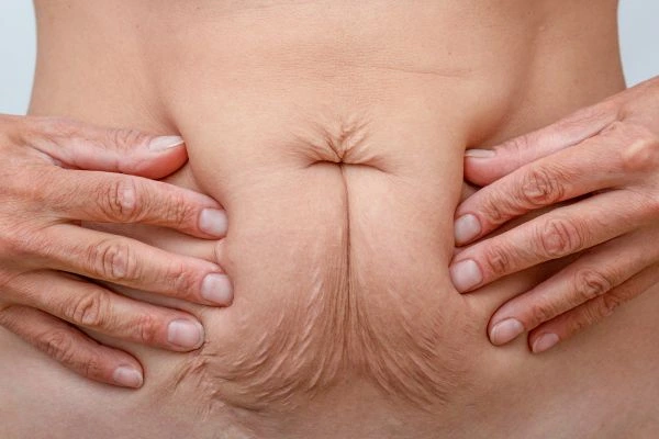 Should I Combine Diastasis Recti Treatment with Body Contouring for Better Results Greenock ?