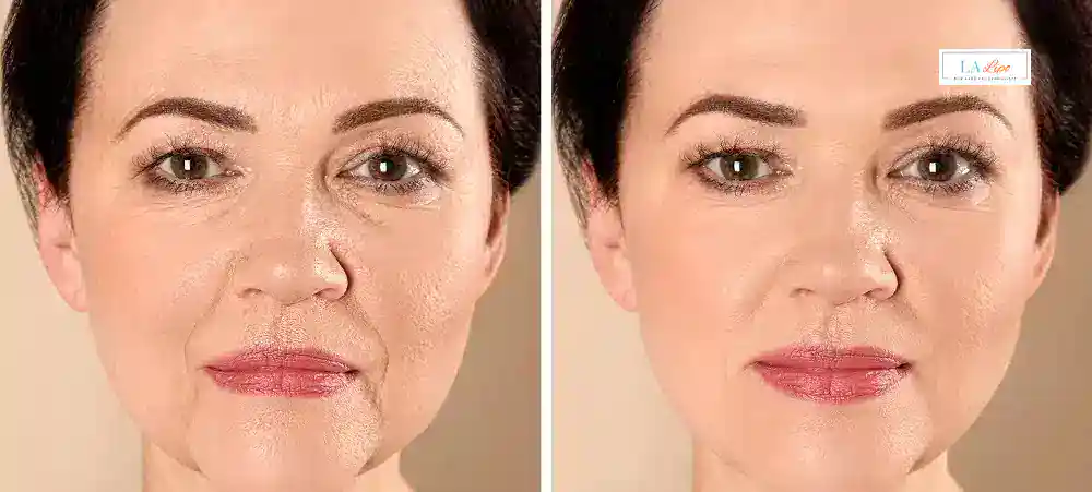 How Long Does It Take to See Results and How Long Do They Last Greenock ?